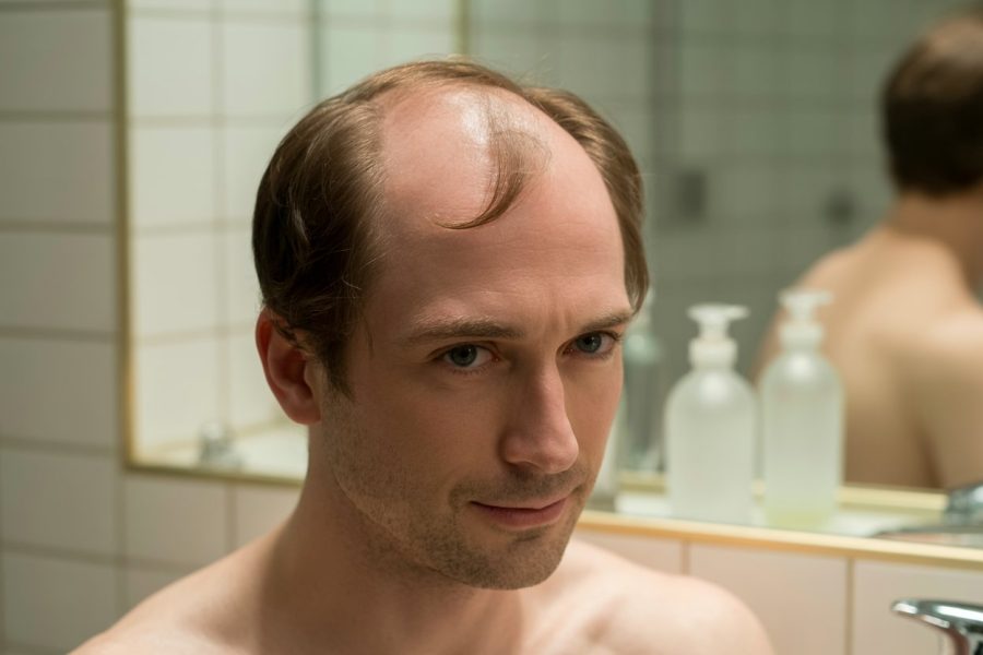 tout comprendxre sur la calvitie du vertex causes solutions et prevention